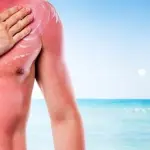 Rimedi naturali per curare una scottatura